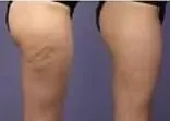 Side-by-side views of the outer thigh