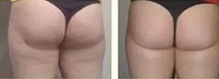 Side-by-side rear views of the hips and upper thighs