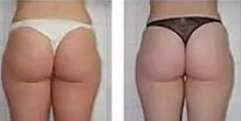 Side-by-side rear views of the hips and thighs