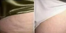 Close-up comparison of skin on the upper thigh