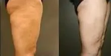 Side-by-side profile views of the upper thigh