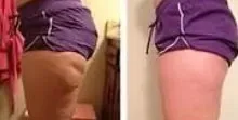 Side-by-side views of the upper thigh beneath purple shorts