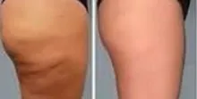 Close-up comparison of skin on the outer thigh
