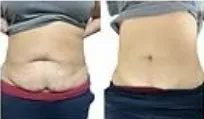 Side-by-side front views of the abdomen