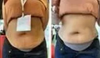 Side-by-side front views of the waist and abdomen