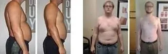 Side and front views of a man shown in a body-contouring comparison